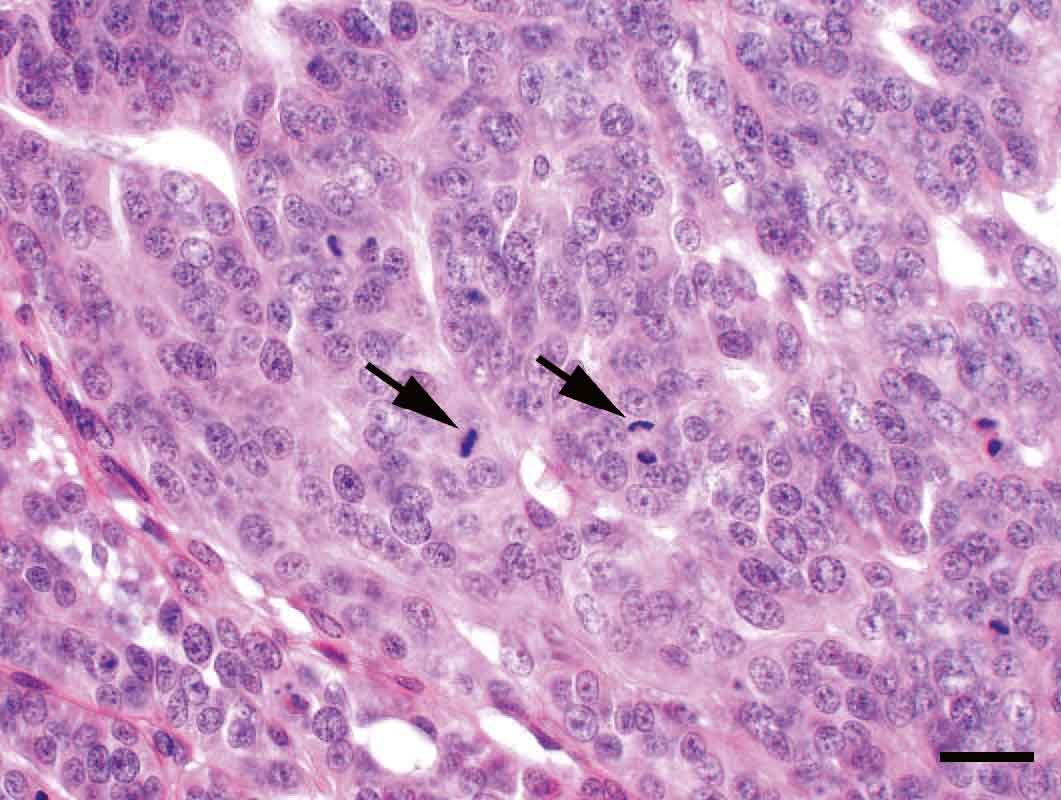 milchdruese-tumor-karzinom