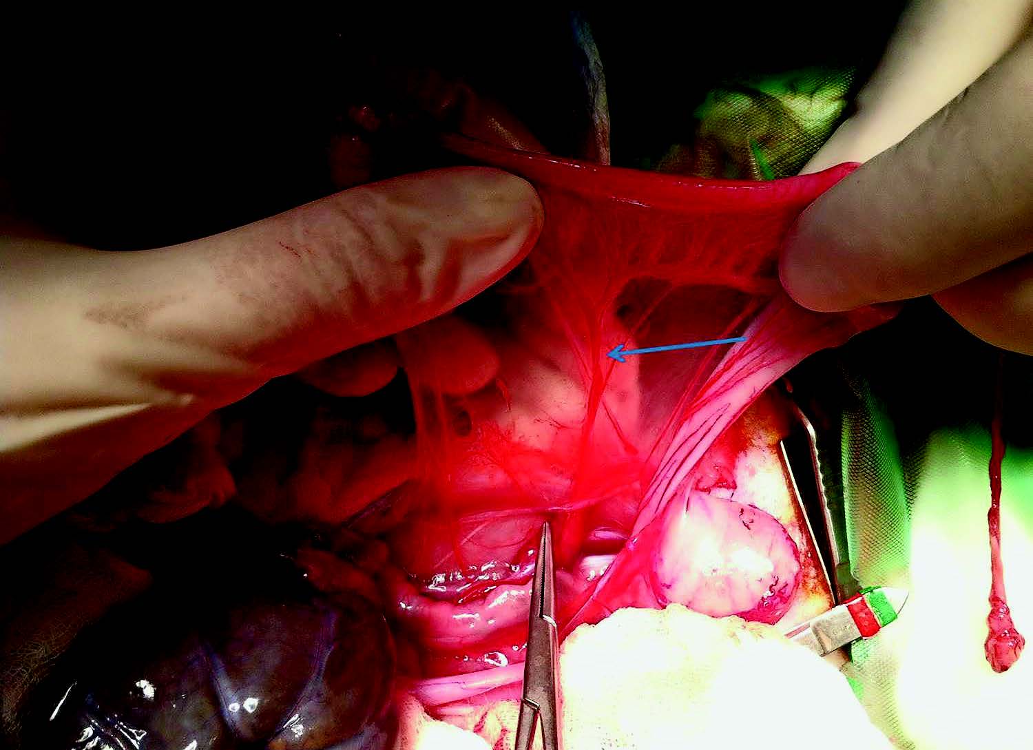 Darstellung der rechten A. uterina (Pfeil) im Ligamentum latum uteri des rechten Uterushorns