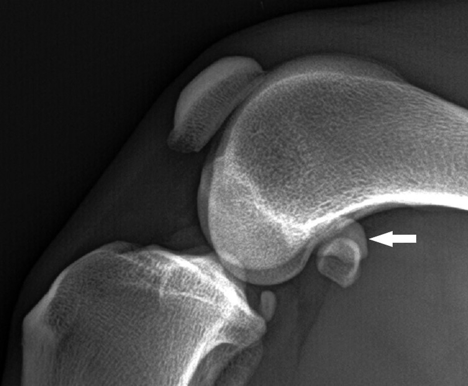 Die proximale Kontur der Fabella ist klar abgrenzbar, die Knochenstruktur ist homogen (Pfeil).