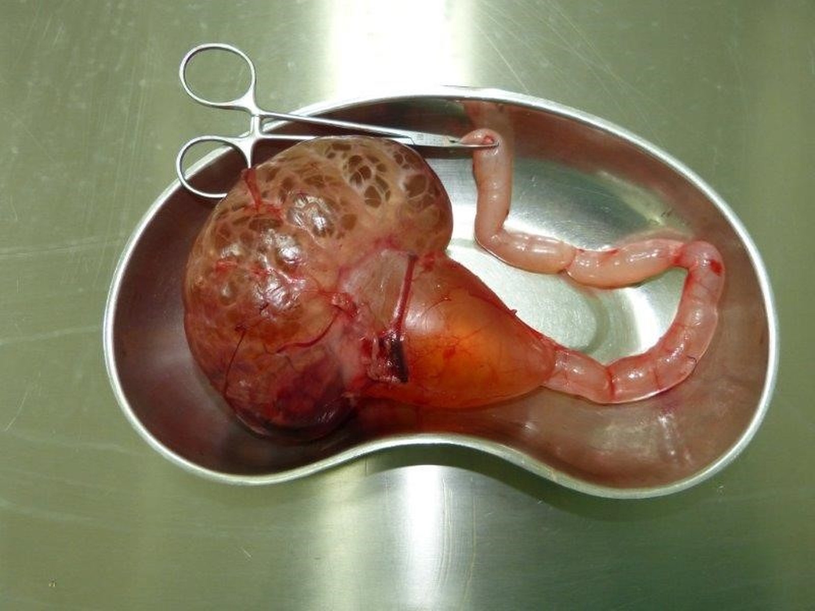 Die entnommene linke Niere mit dilatiertem Harnleiter 