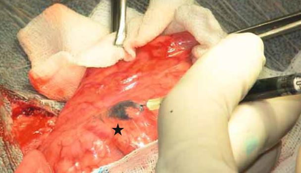 Intraoperative Injektion von Methylenblau in einen Mesenteriallymphknoten