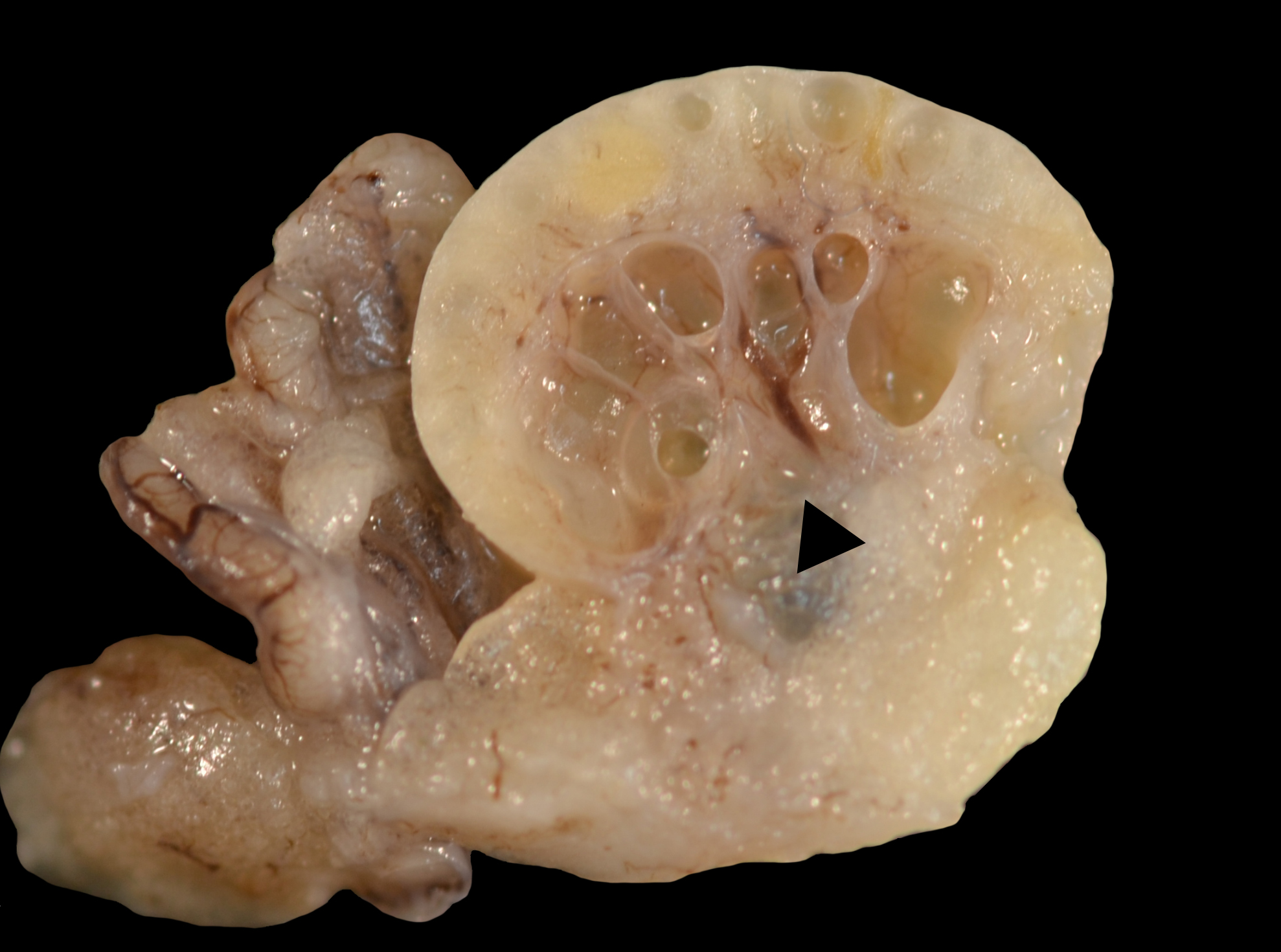 Makroskopisches Bild von gekammerten Rete-ovarii-Zysten