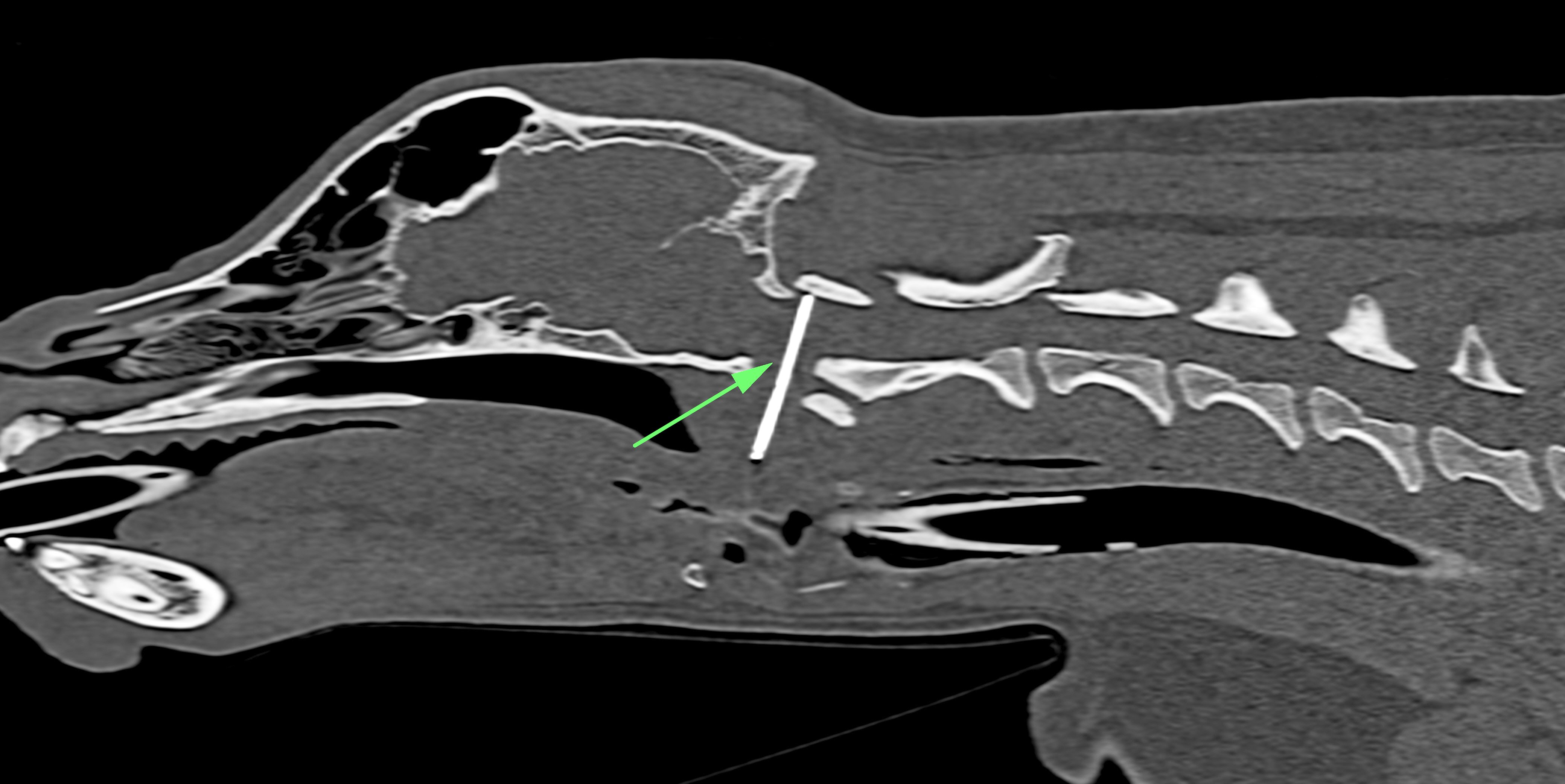 Sagittale Rekonstruktion der Halswirbelsäule, welche einen linearen metallischen Fremdkörper im Atlantookzipitalgelenk zeigt