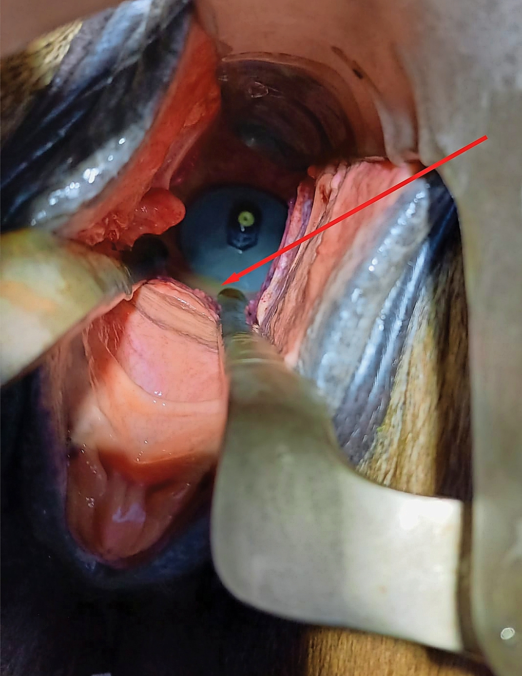 Abb. 5: Blick auf die intravaginale Scheibe. Der Stent ist zu diesem Zeitpunkt schon seit fünf Monaten implantiert. Der rote Pfeil zeigt auf den Flüssigkeitssee vor der intravaginalen Scheibe.