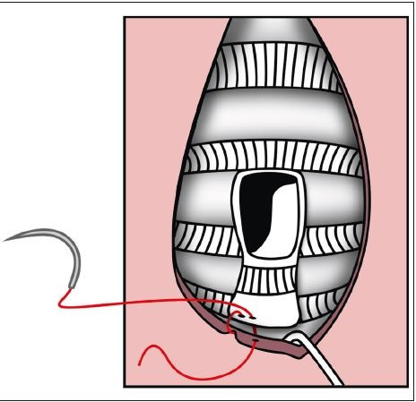 Fig. 4: Schematic representation of the Björk flap. Inverted U-shaped tracheal flap sutured to the lower edge of the skin
